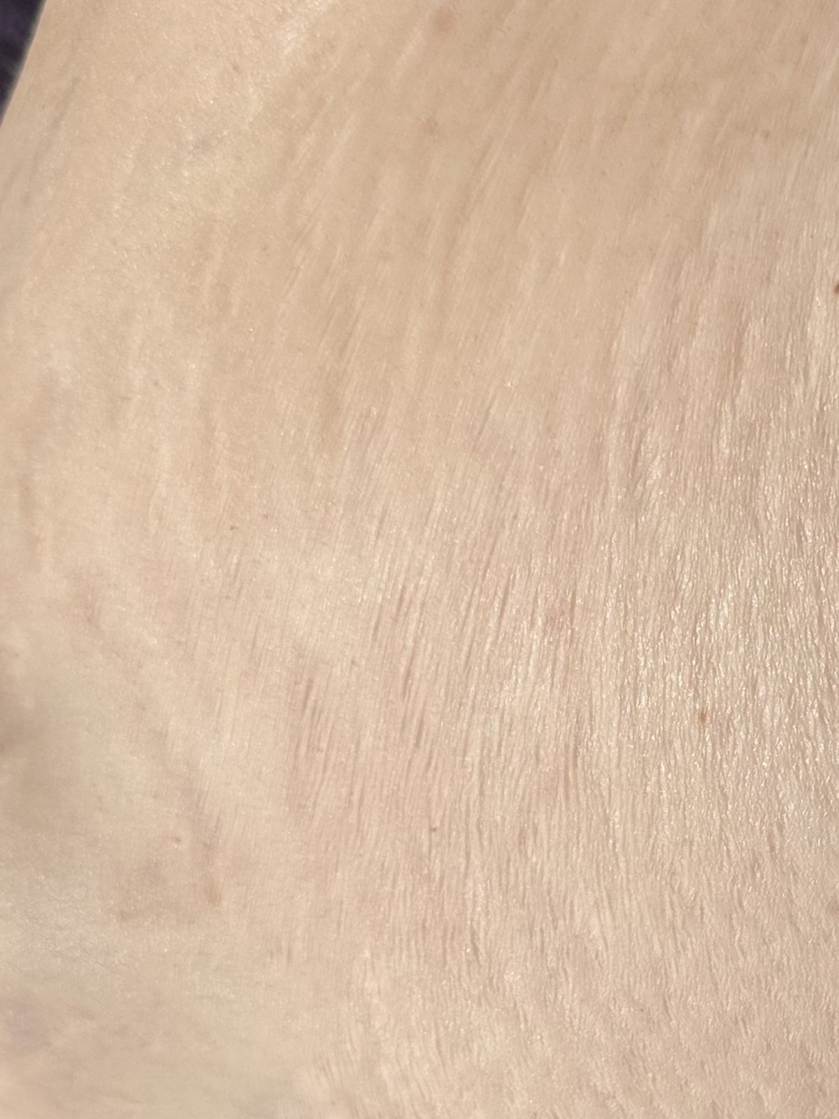 Healed stretch marks after camouflage by Nurse Leslie