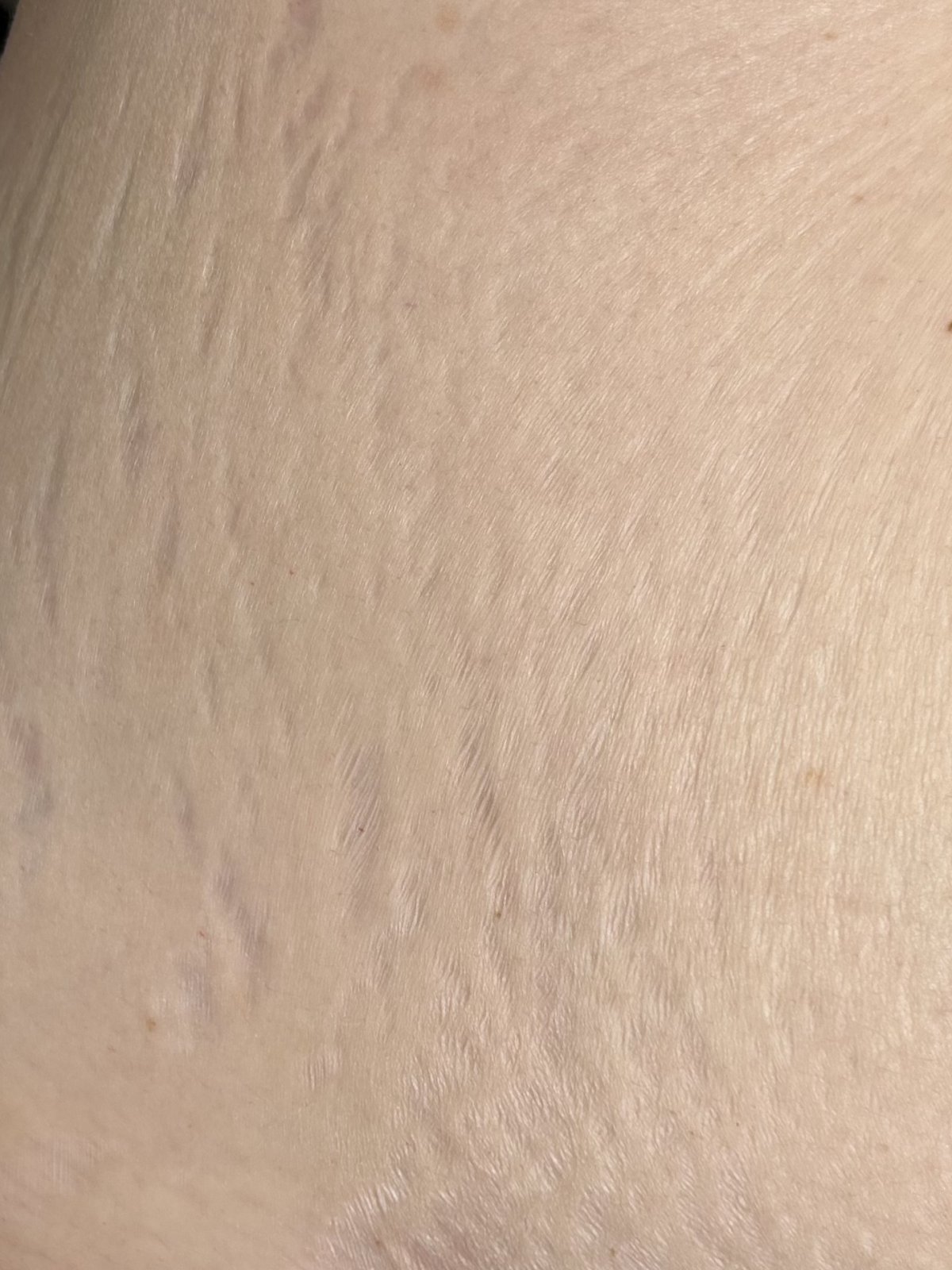Stretch marks before camouflage