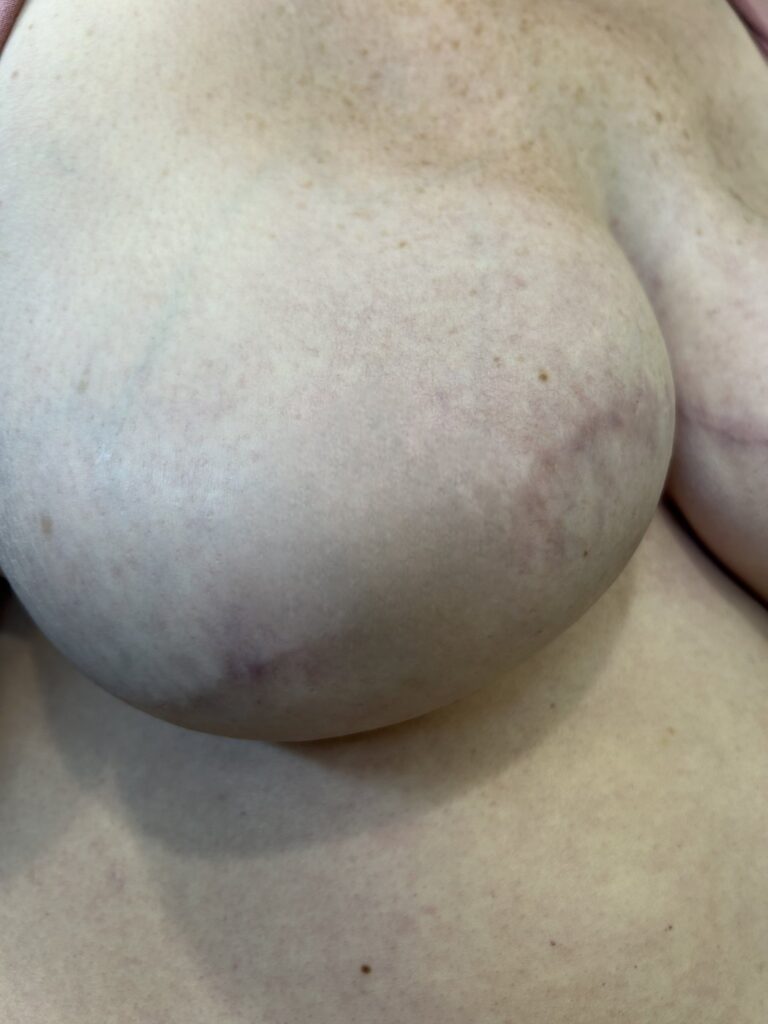 Breast after reconstruction, before areola tattooing