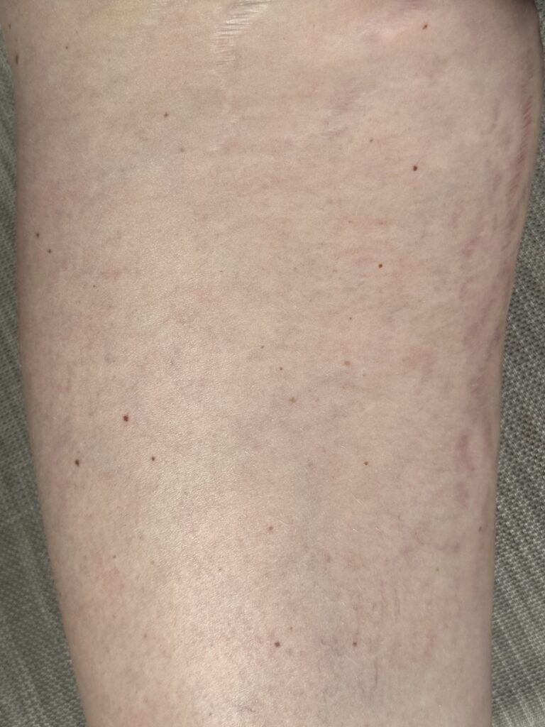 Healed stretch marks after camouflage by Nurse Leslie