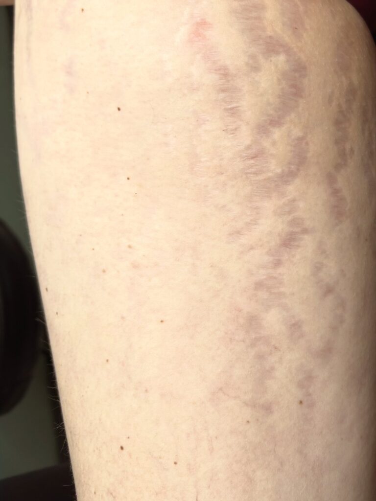 Stretch marks before camouflage