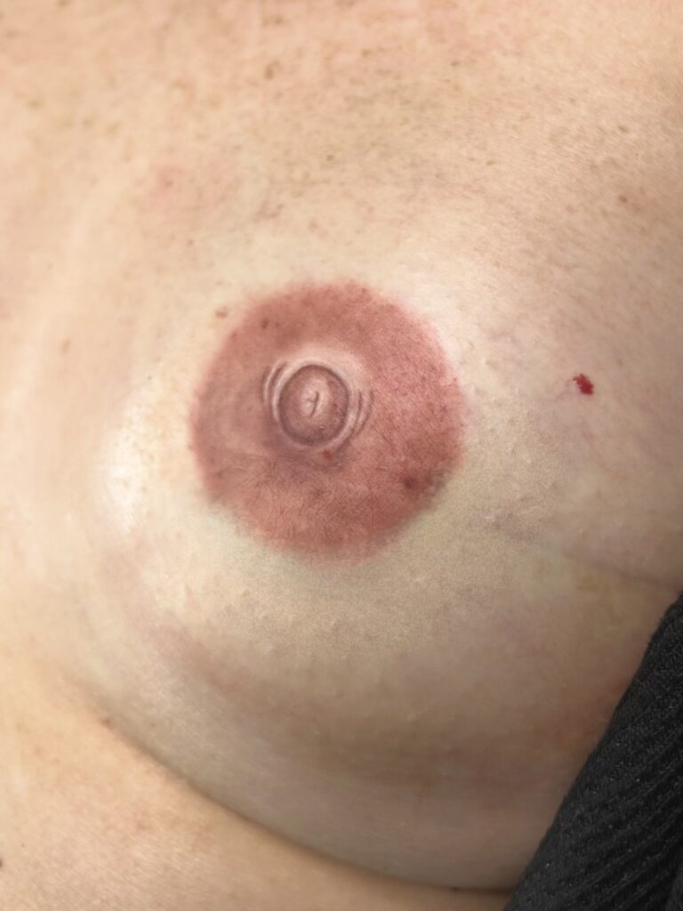 After 3D nipple and areola restoration by Nurse Leslie