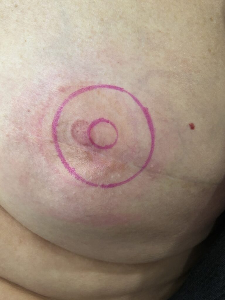 Breast after reconstruction, before areola tattooing